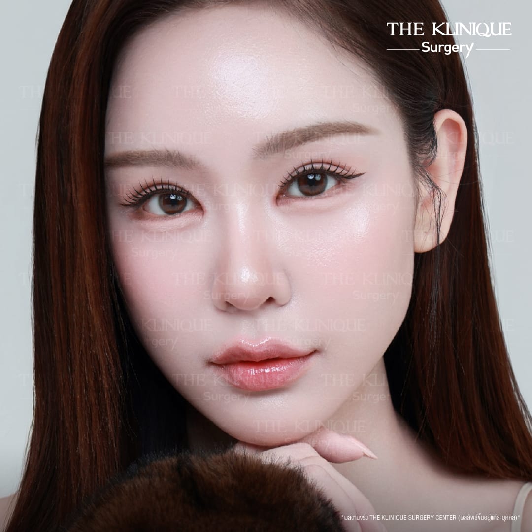 รีวิวแก้ตาสองชั้น ลดขนาดชั้นตาที่ใหญ่