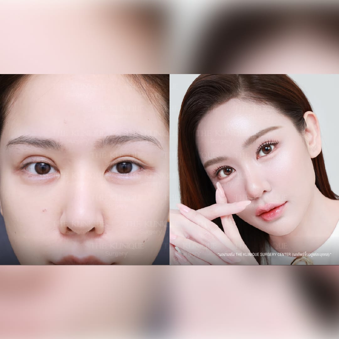 รีวิวแก้ตาสองชั้น ลดขนาดชั้นตาที่ใหญ่
