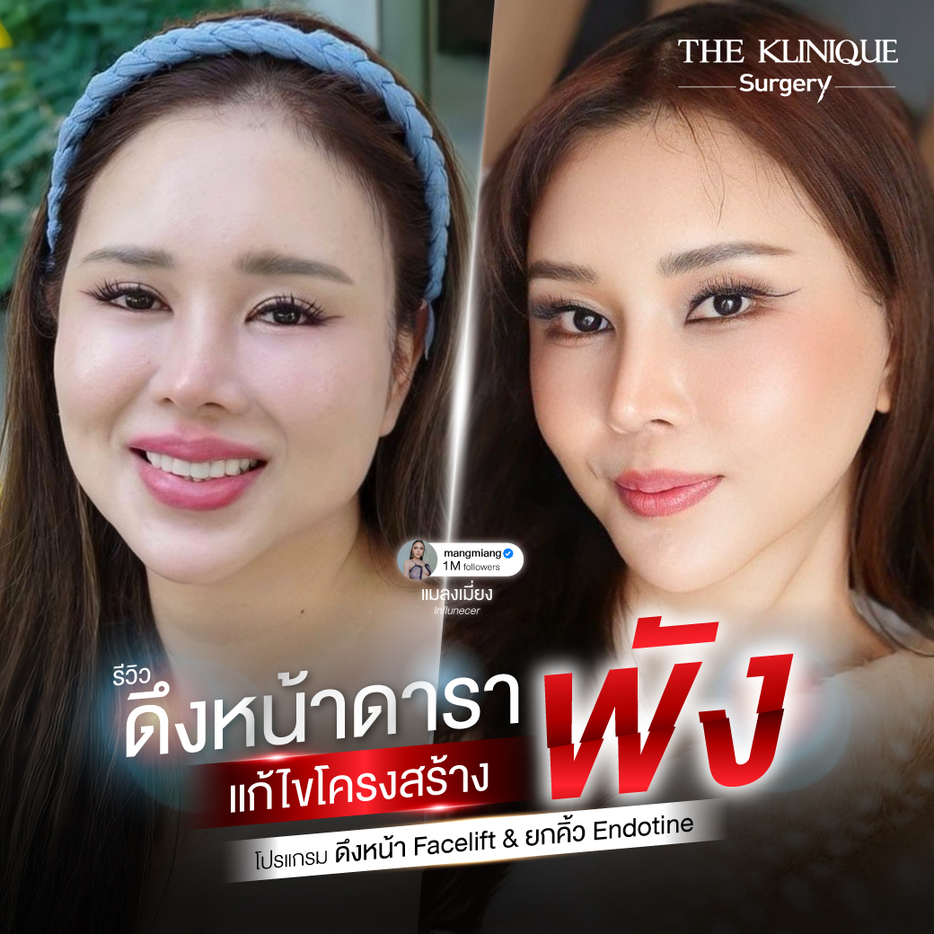 รีวิวดึงหน้า-facelift-ยกคิ้ว-endotine-ดึงหน้าดารา-คุณแมลงเมี่ยง