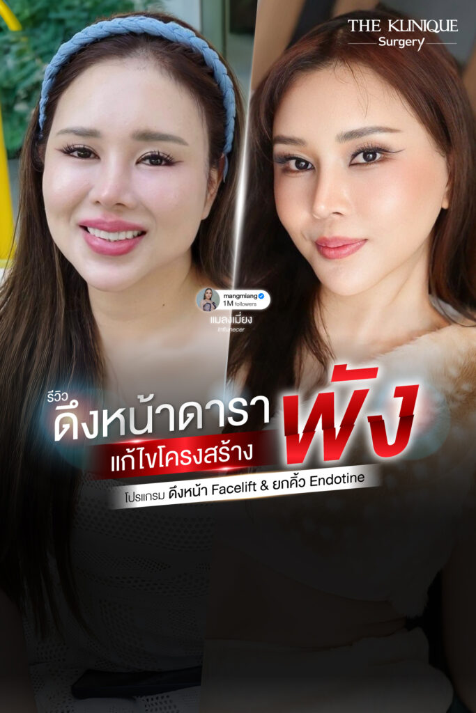 รีวิวดึงหน้า-facelift-ยกคิ้ว-endotine-ดึงหน้าดารา-คุณแมลงเมี่ยง