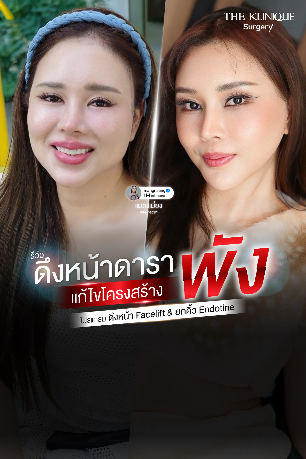 รีวิวดึงหน้า-facelift-ยกคิ้ว-endotine-ดึงหน้าดารา-คุณแมลงเมี่ยง