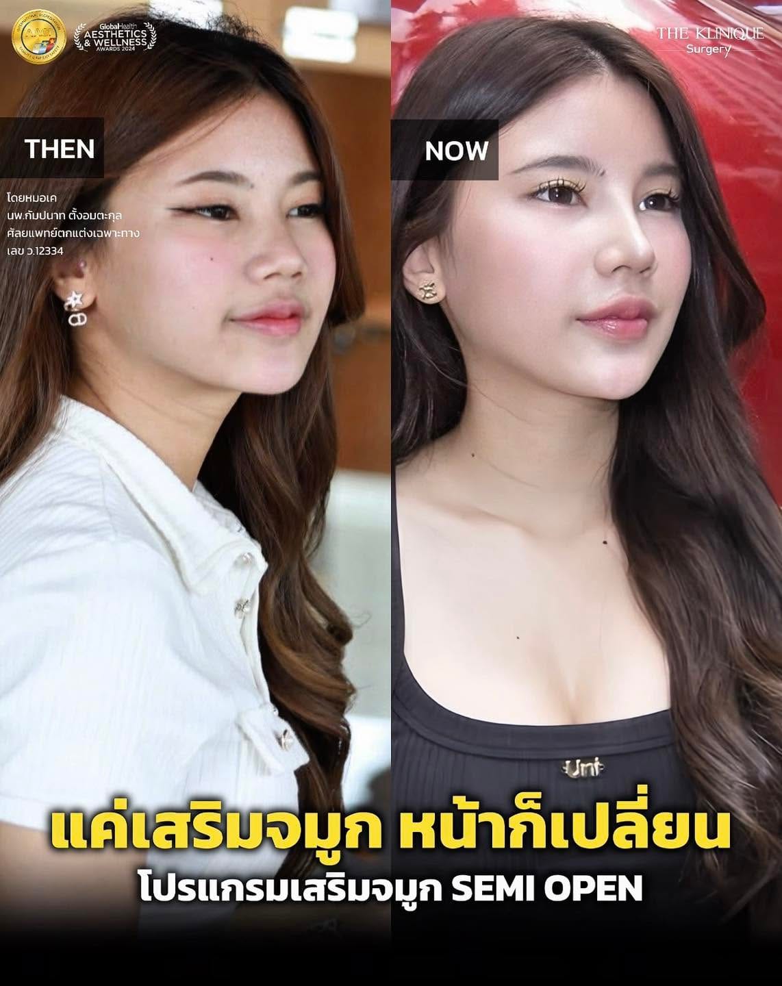 รีวิวเสริมจมูก Semi Open หมอเค