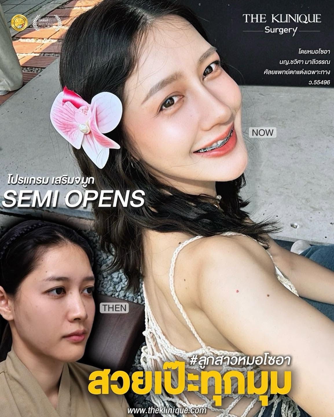 รีวิวเสริมจมูก Semi Open หมอโซอา