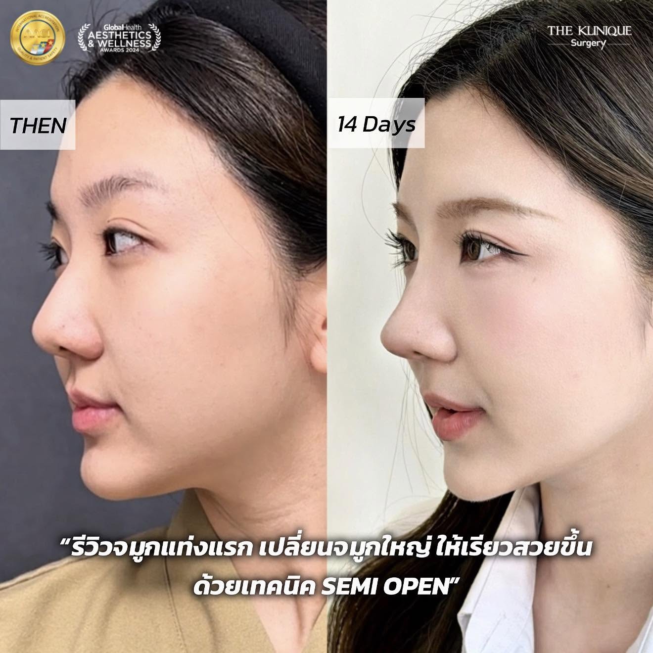 รีวิวเสริมจมูก Semi Open หมอซาน