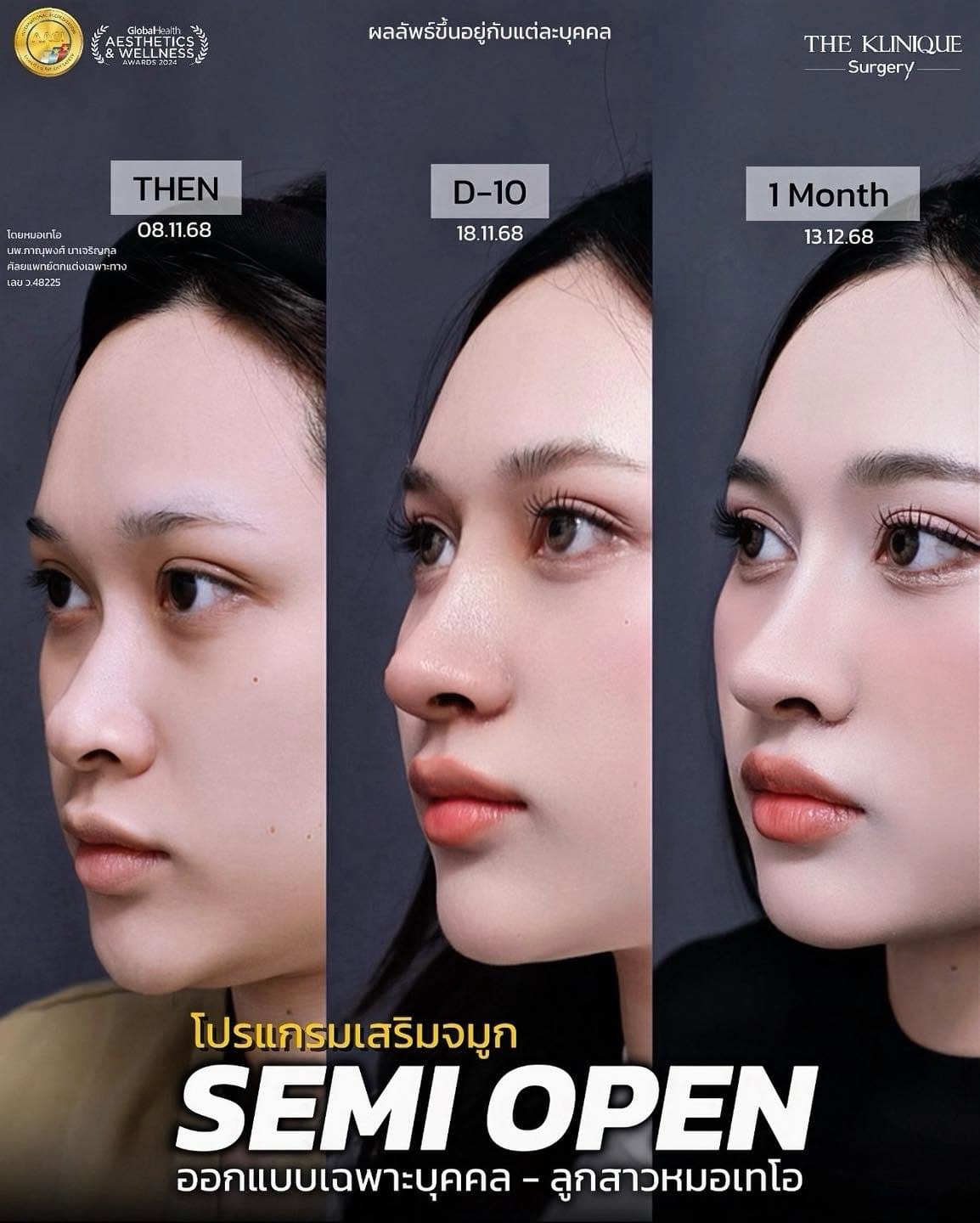 รีวิวเสริมจมูก Semi Open หมอเทโอ