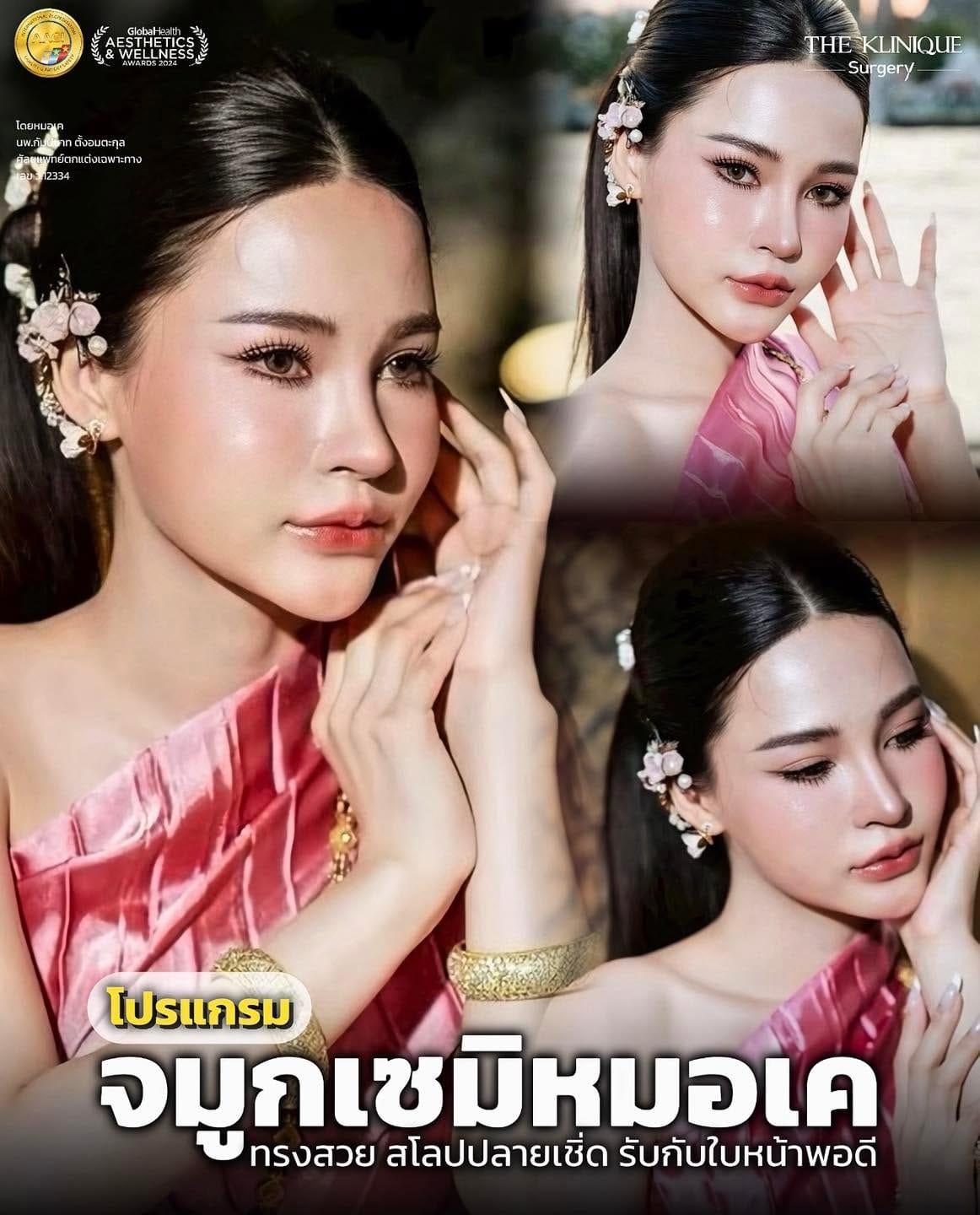 รีวิวเสริมจมูก Semi Open หมอเค