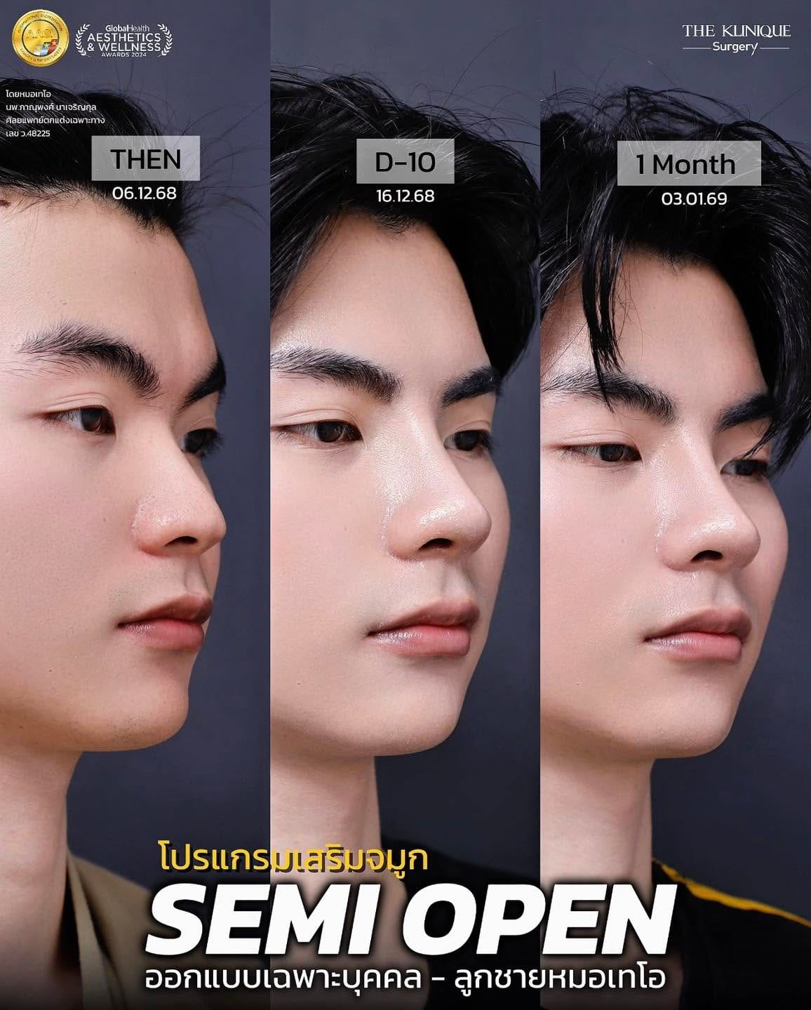 รีวิวเสริมจมูก Semi Open หมอเทโอ
