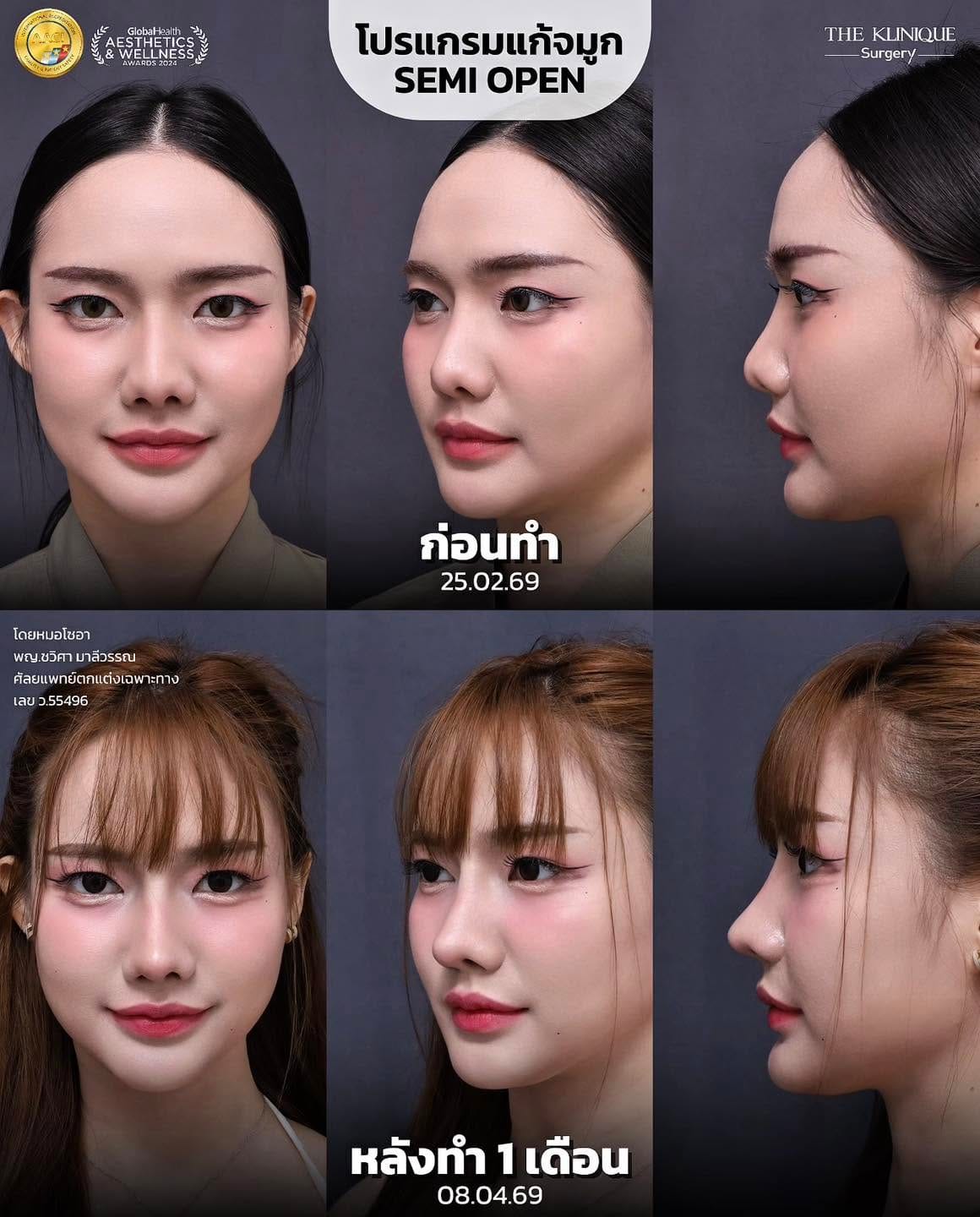 การดูแลหลัง เสริมจมูก Semi Open