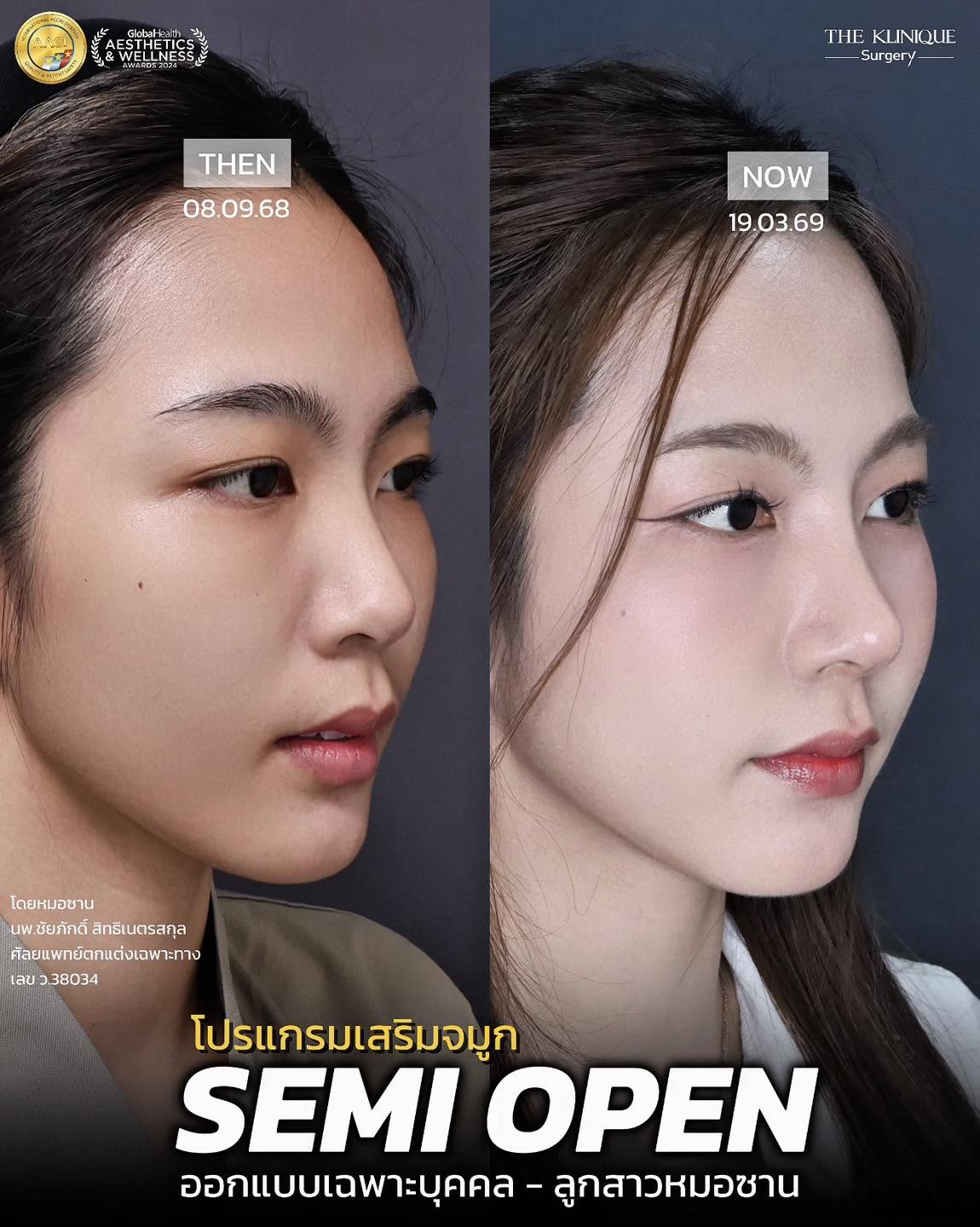 รีวิวเสริมจมูก Semi Open หมอซาน