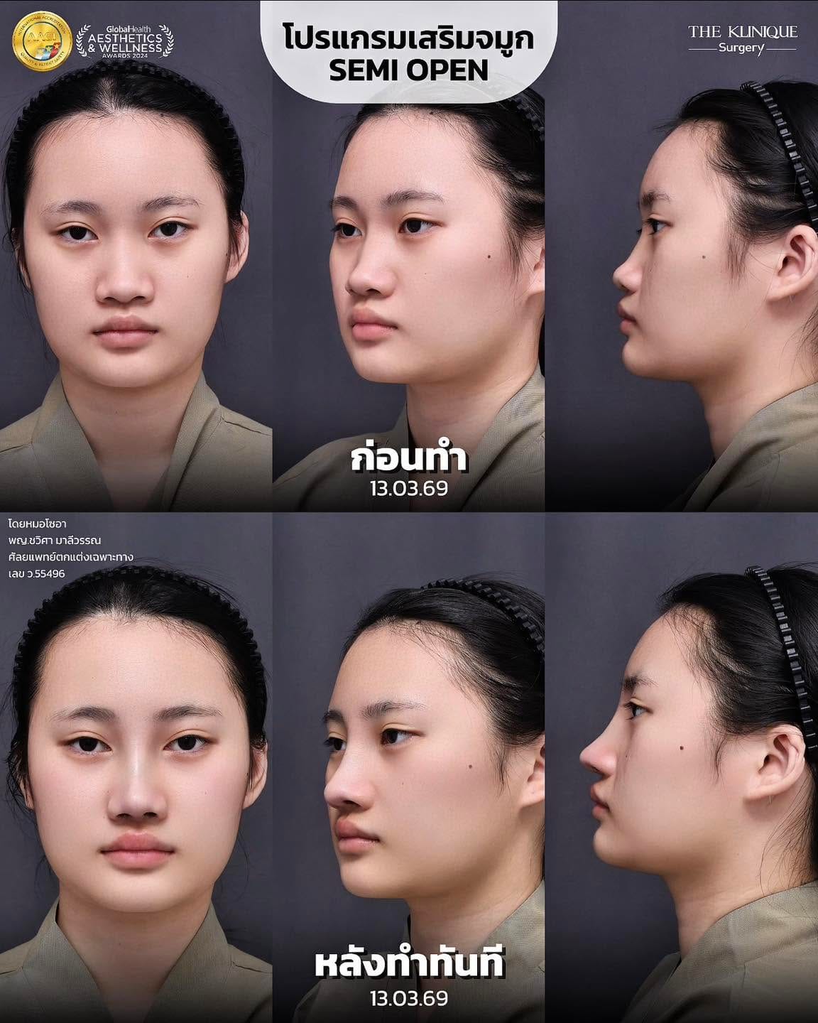 การดูแลหลัง เสริมจมูก Semi Open