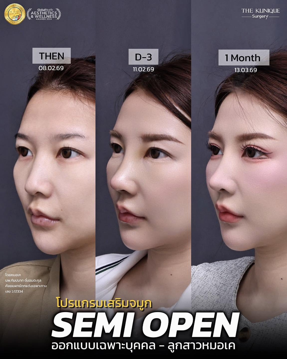 รีวิวเสริมจมูก Semi Open หมอเค