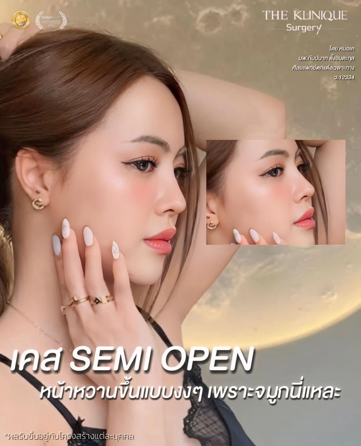 รีวิวเสริมจมูก Semi Open หมอเค