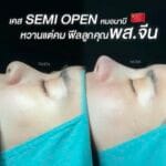 รีวิวเสริมจมูก Semi Open หมอนาบี