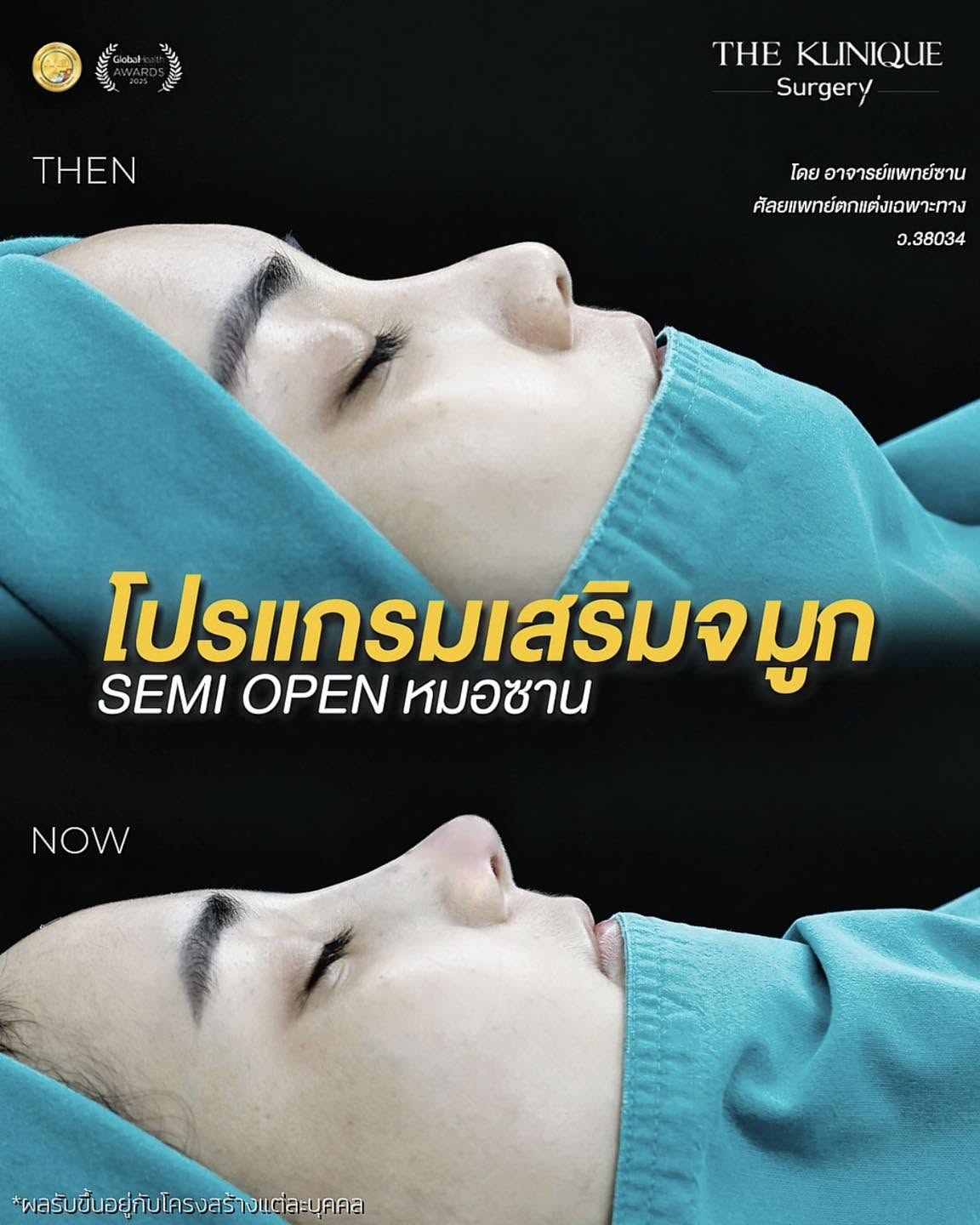 รีวิวเสริมจมูก Semi Open หมอซาน