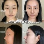 รีวิวเสริมจมูก Semi Open หมอนาบี