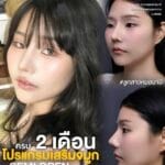 รีวิวเสริมจมูก Semi Open หมอนาบี