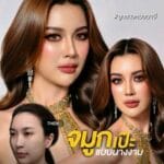 รีวิวเสริมจมูก Semi Open หมอนาบี