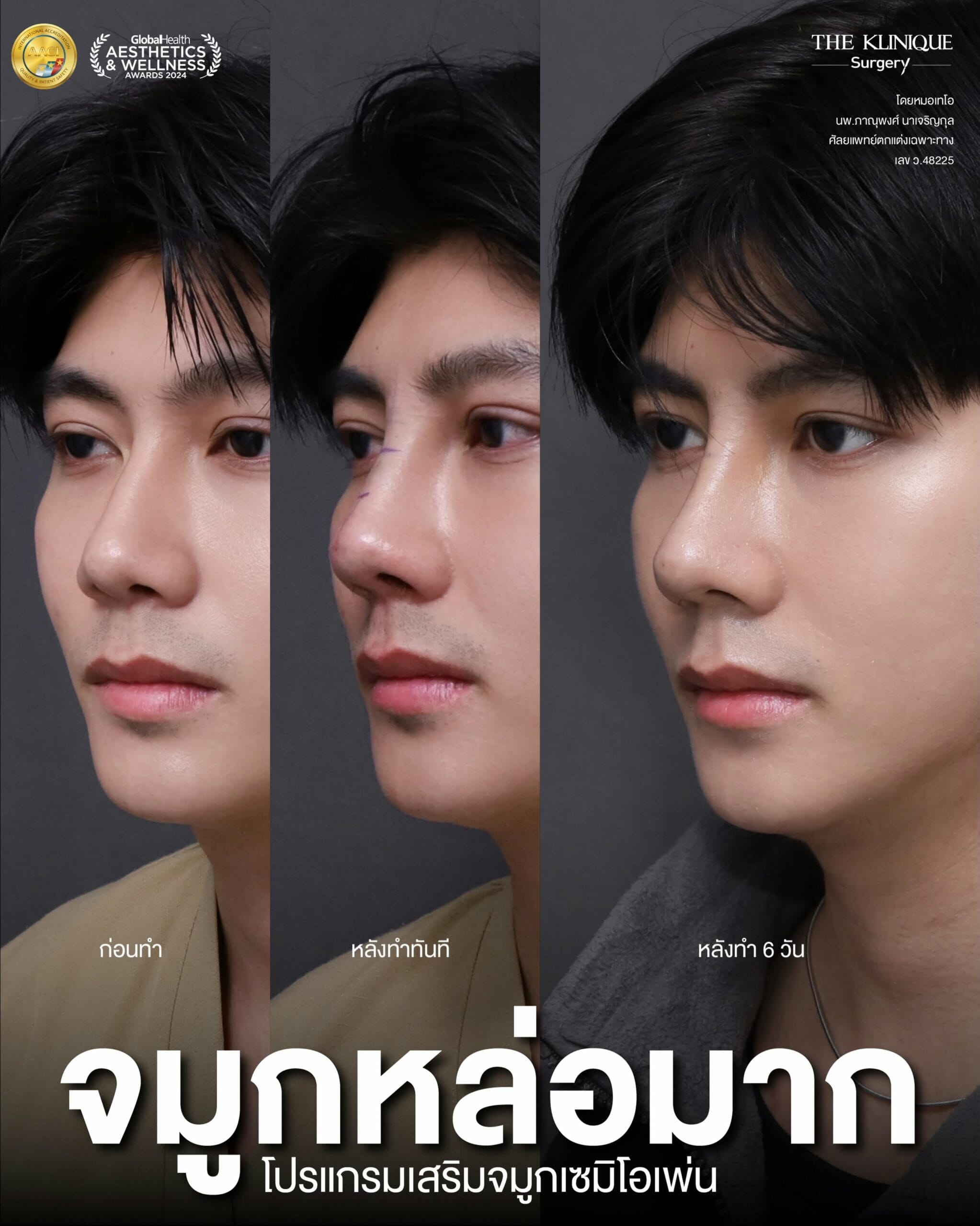 รีวิวเสริมจมูก Semi Open หมอเทโอ