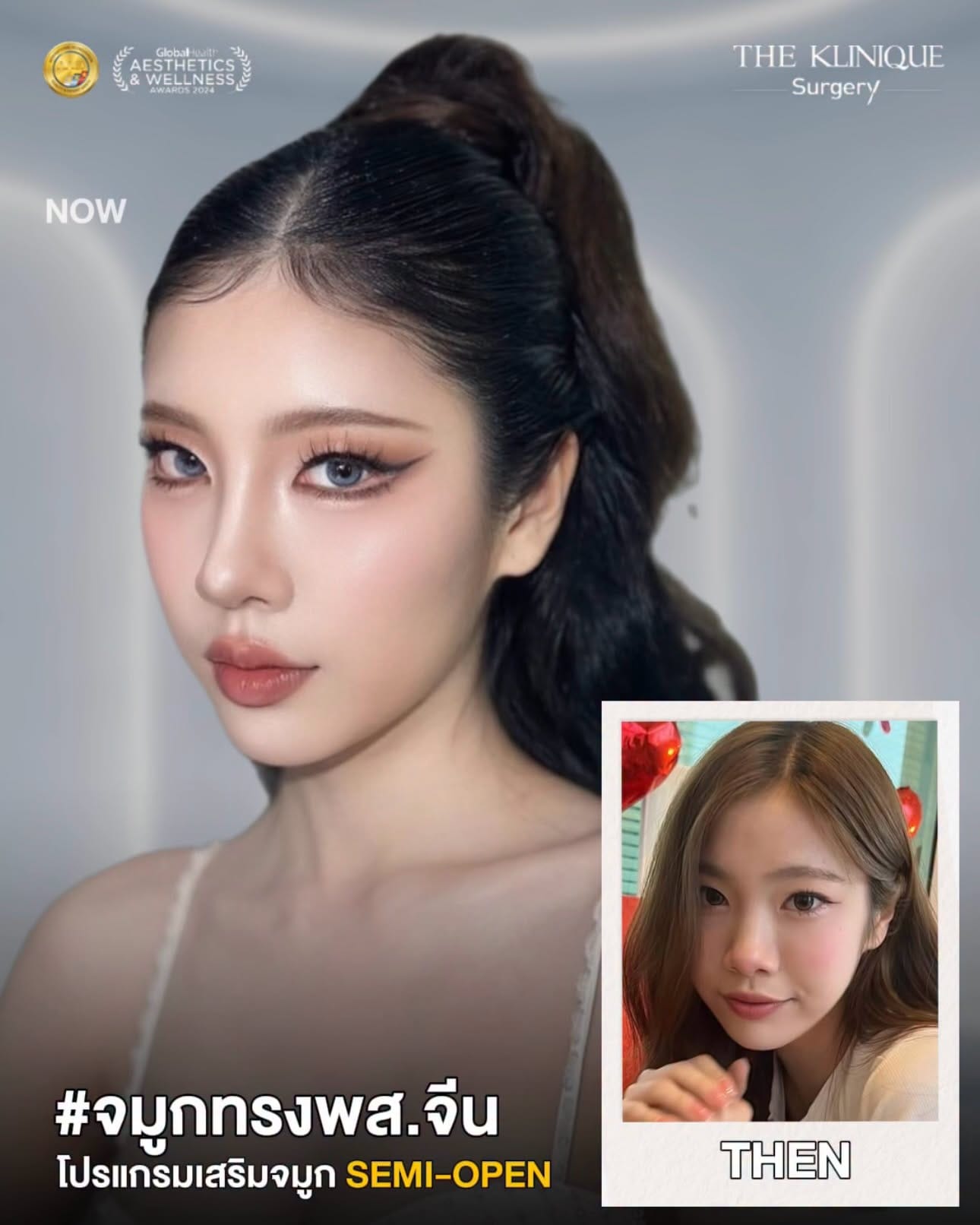 รีวิวเสริมจมูก Semi Open หมอเค