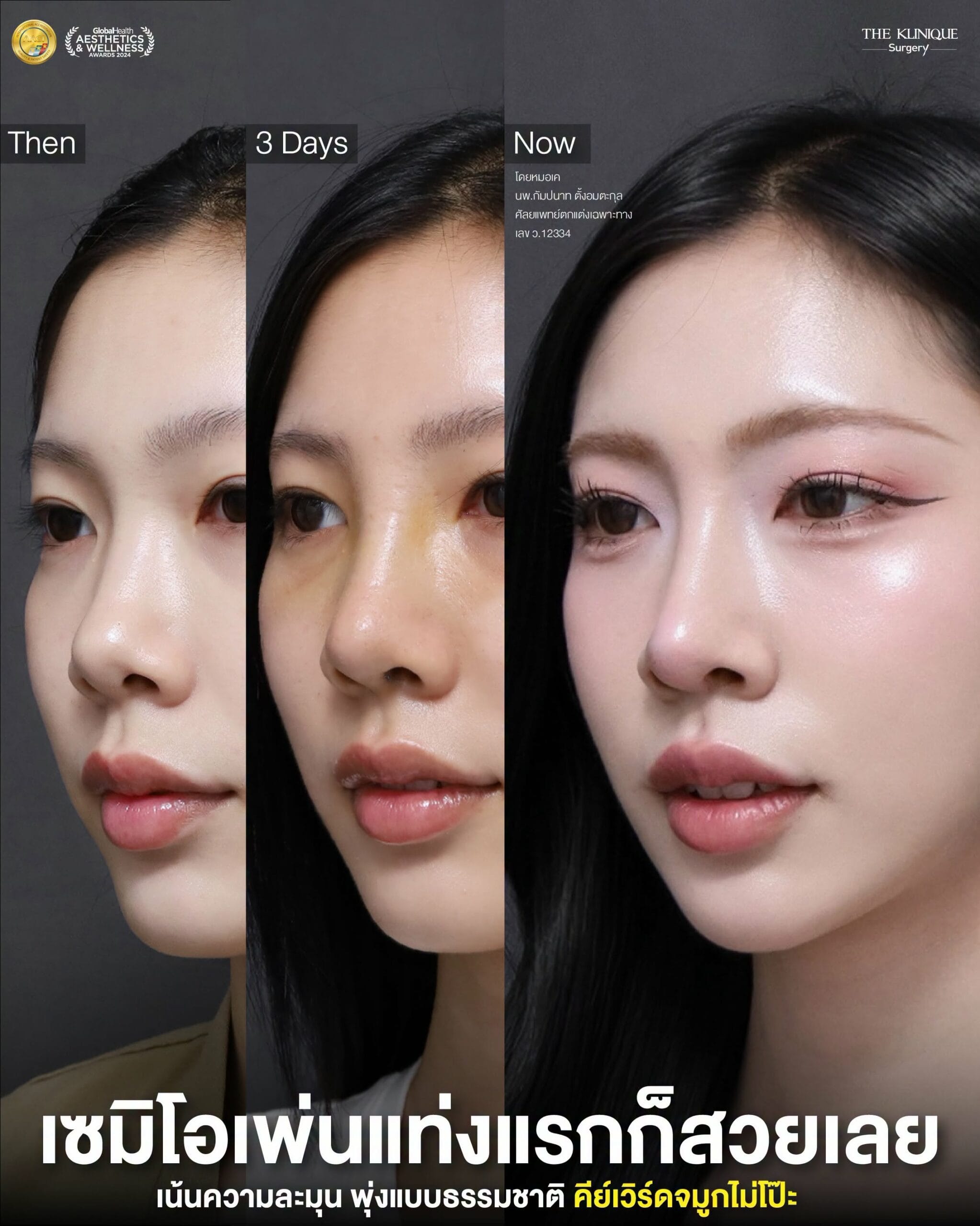 รีวิวเสริมจมูก Semi Open หมอเค