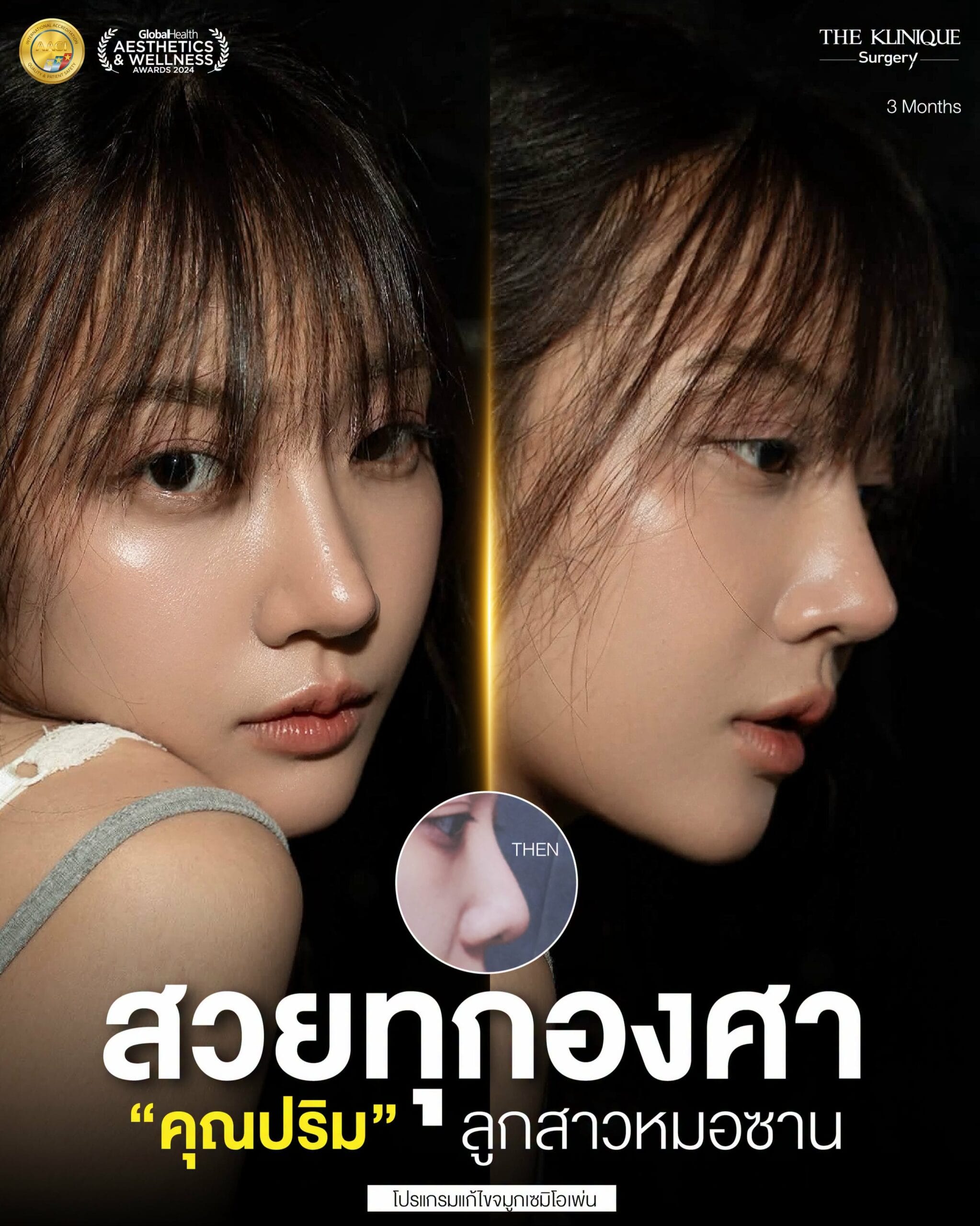 รีวิวเสริมจมูก Semi Open หมอซาน
