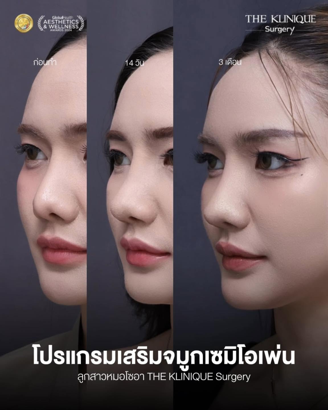การดูแลหลัง เสริมจมูก Semi Open
