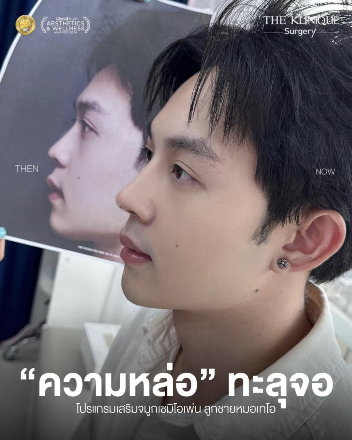 รีวิวเสริมจมูก Semi Open หมอเทโอ