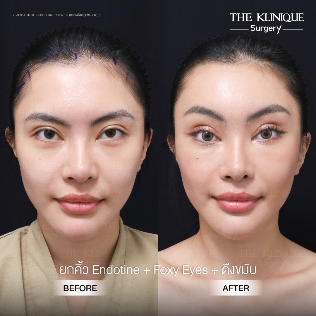 หมอเทโอ เสริมจมูก