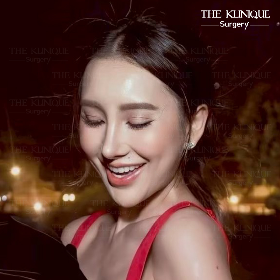รีวิวเสริมจมูกโอเพ่น หมอฮง