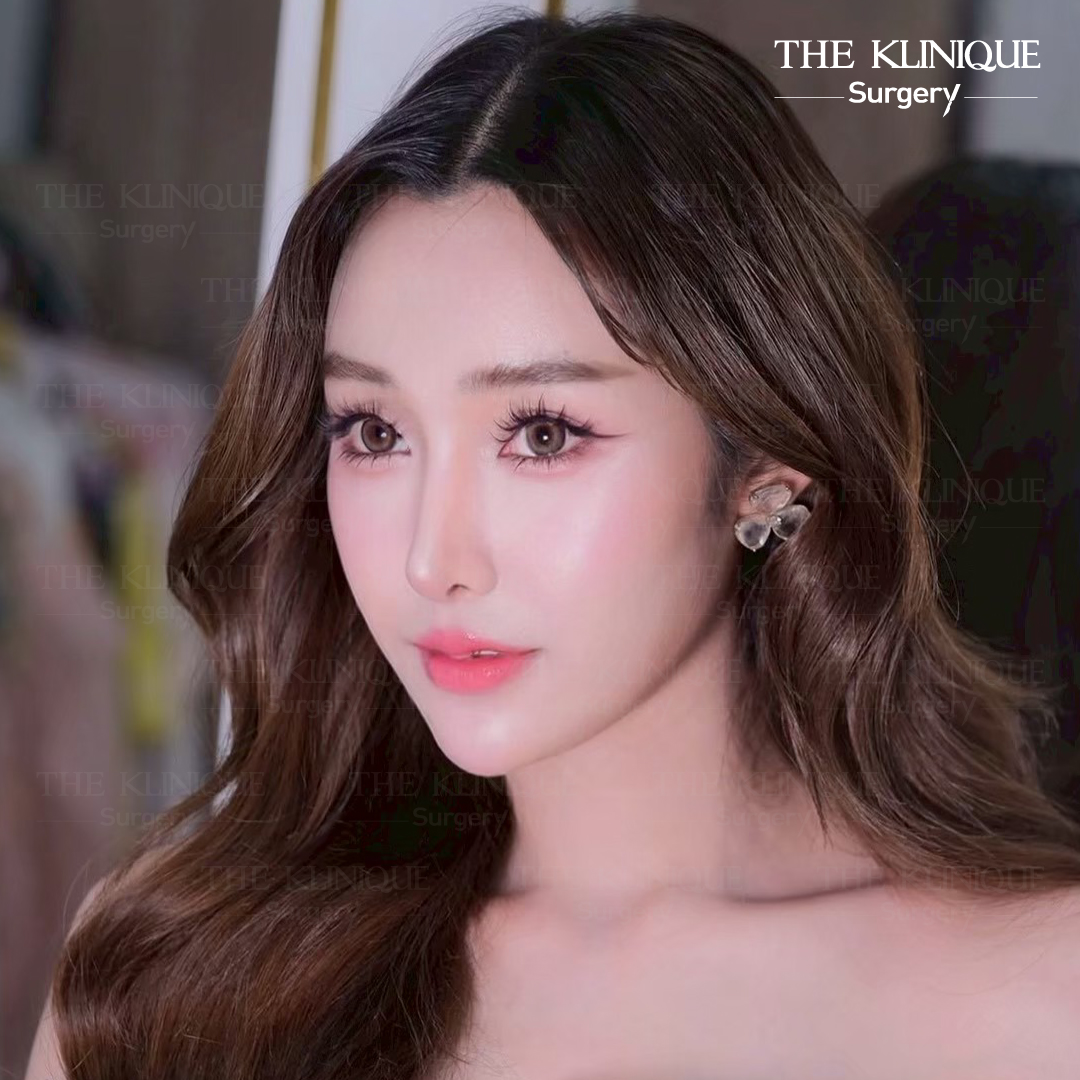 รีวิวเสริมจมูกโอเพ่น หมอฮง