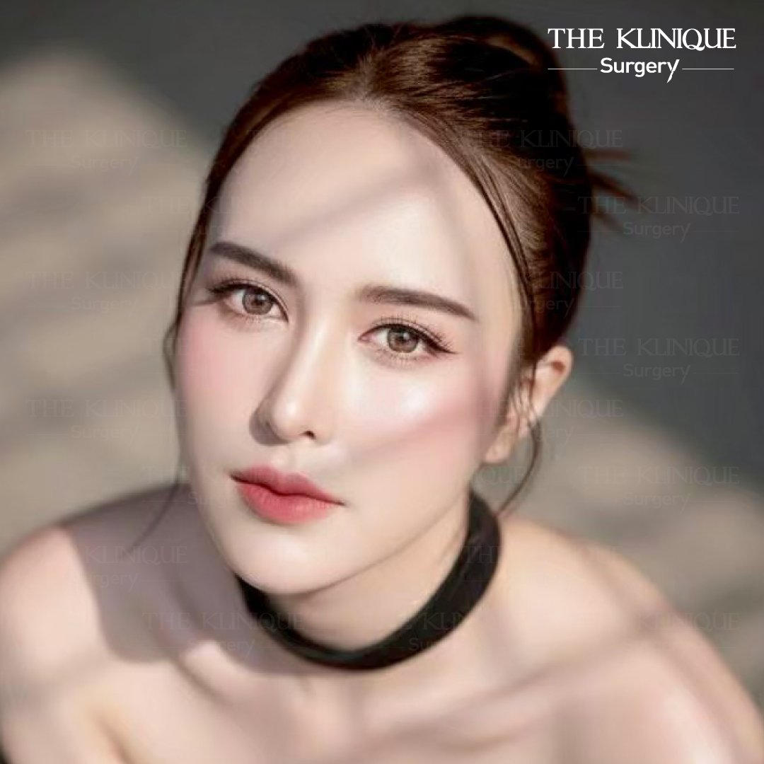 รีวิวเสริมจมูกโอเพ่น หมอฮง