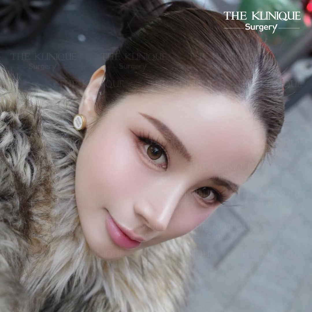 รีวิวเสริมจมูกโอเพ่น หมอฮง