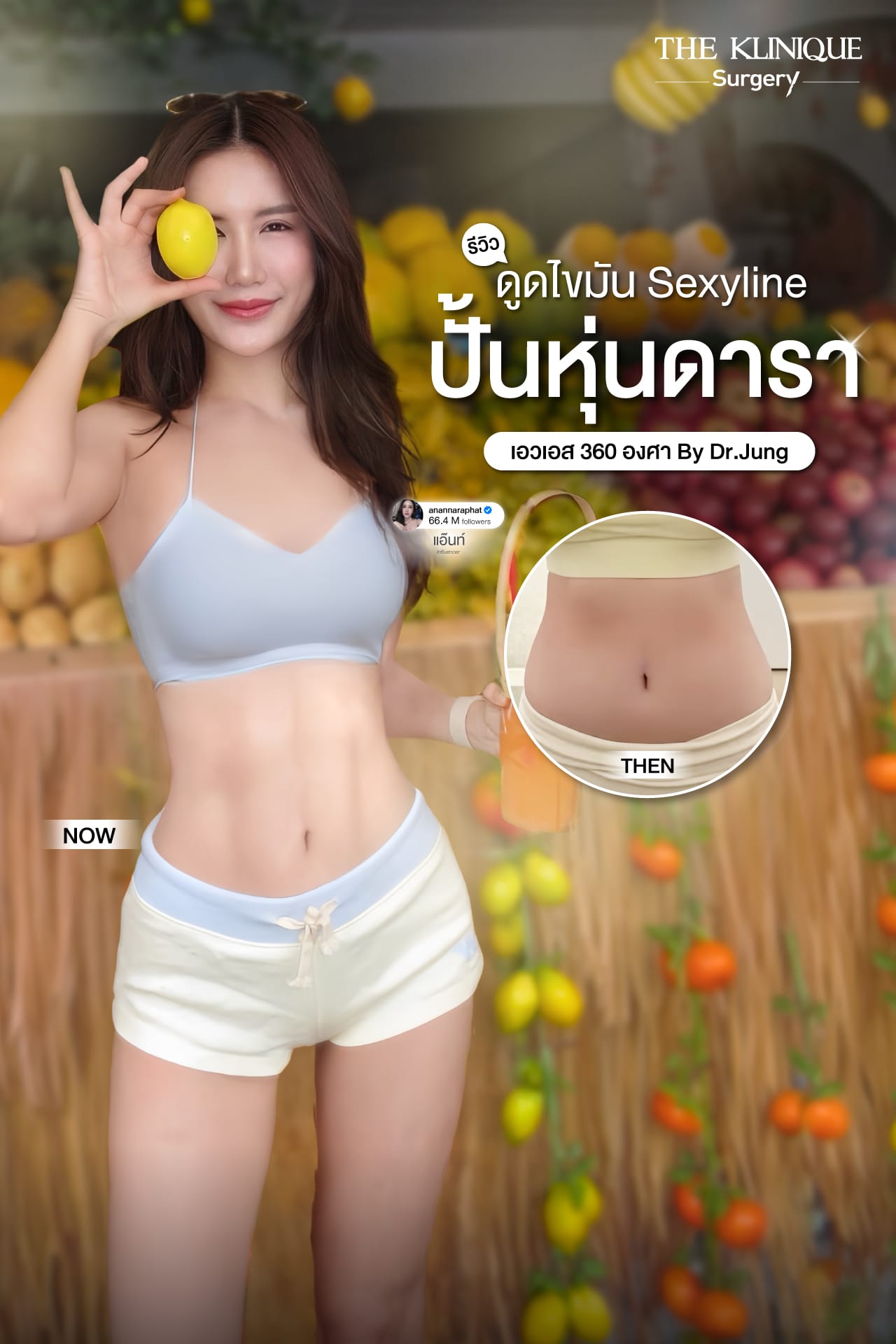 รีวิว ดูดไขมัน Sexyline หน้าท้อง