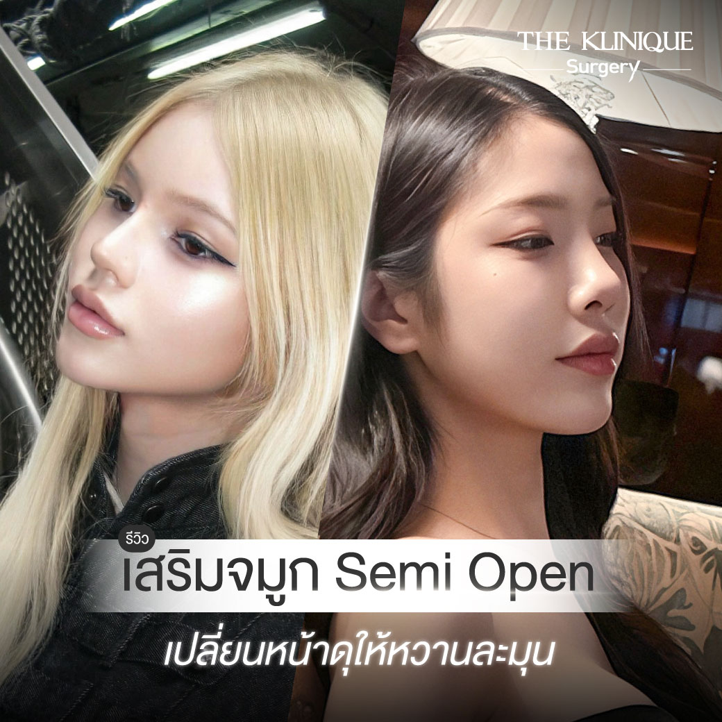รีวิวเสริมจมูก Semi Open เคสสาวสอง ปรับหน้าหวาน โดย หมอเค