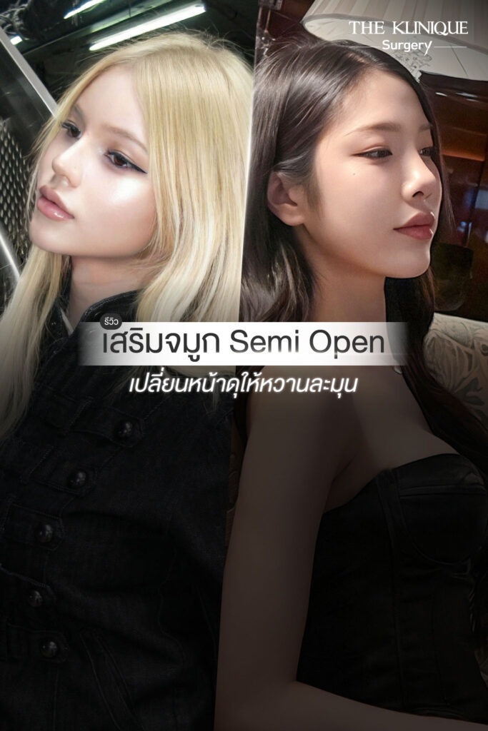 รีวิวเสริมจมูก Semi Open เคสสาวสอง ปรับหน้าหวาน โดย หมอเค