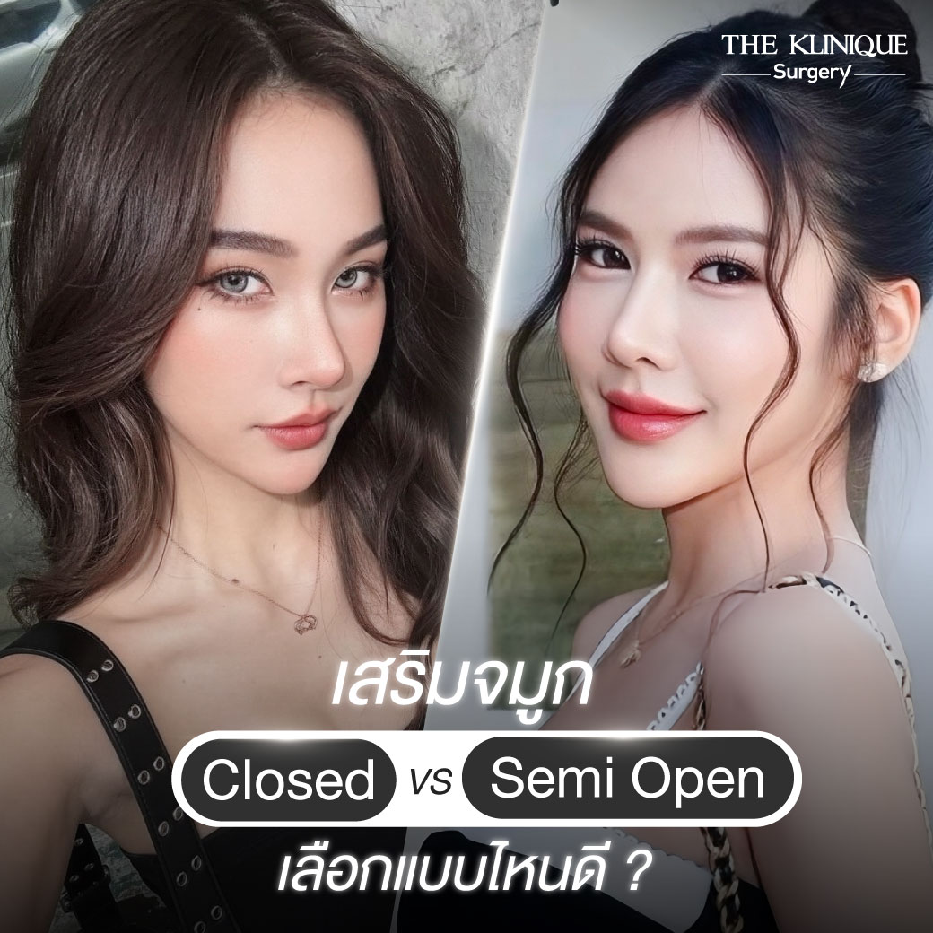 รีวิวเสริมจมูกเทคนิค Semi Open และ Closed ปรับทรงสวย