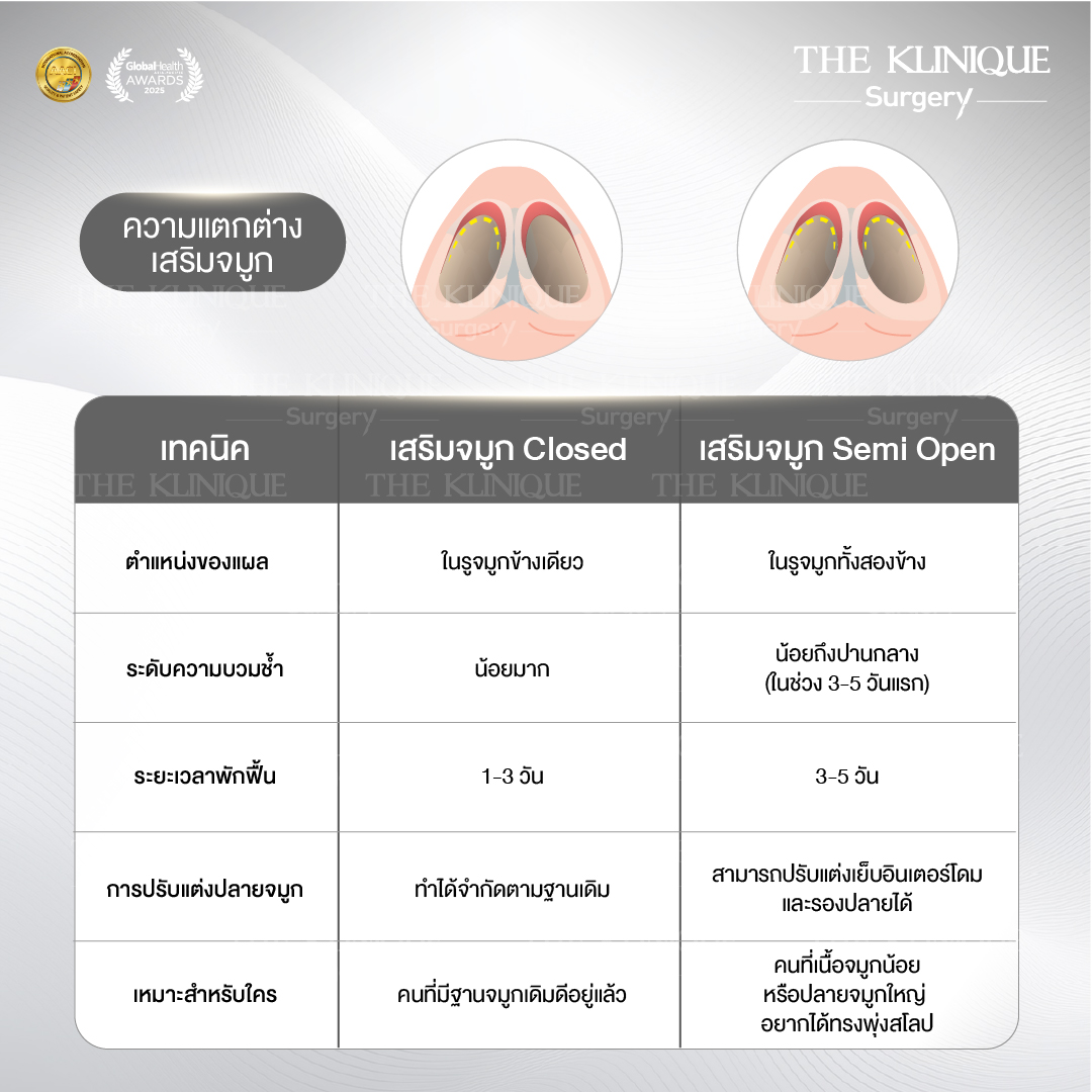 รีวิวเสริมจมูกเทคนิค Semi Open และ Closed ปรับทรงสวย