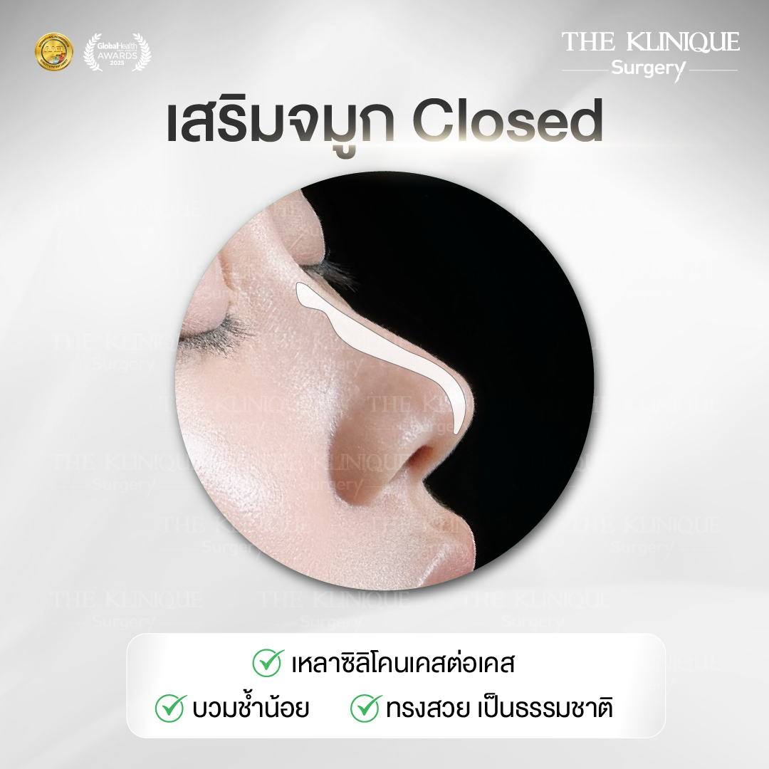 รีวิวเสริมจมูกเทคนิค Closed