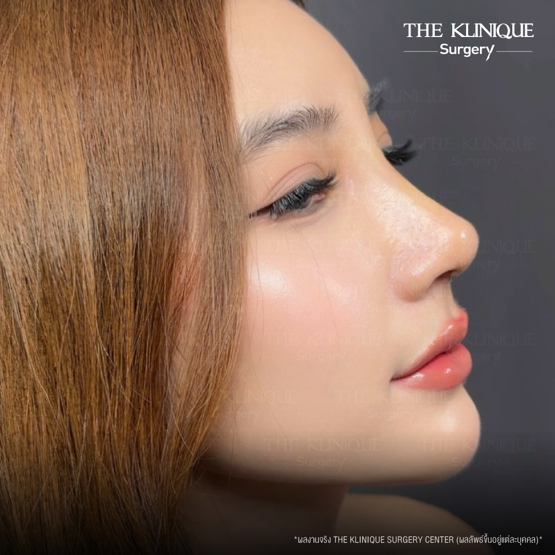 รีวิว หมอบิ๊ก เสริมจมูก เทคนิค OPEN