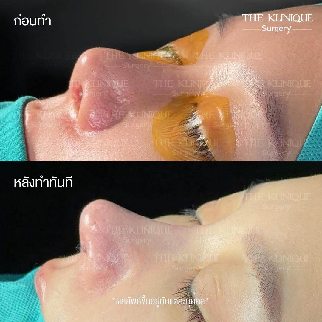 รีวิว หมอบิ๊ก เสริมจมูก เทคนิค OPEN