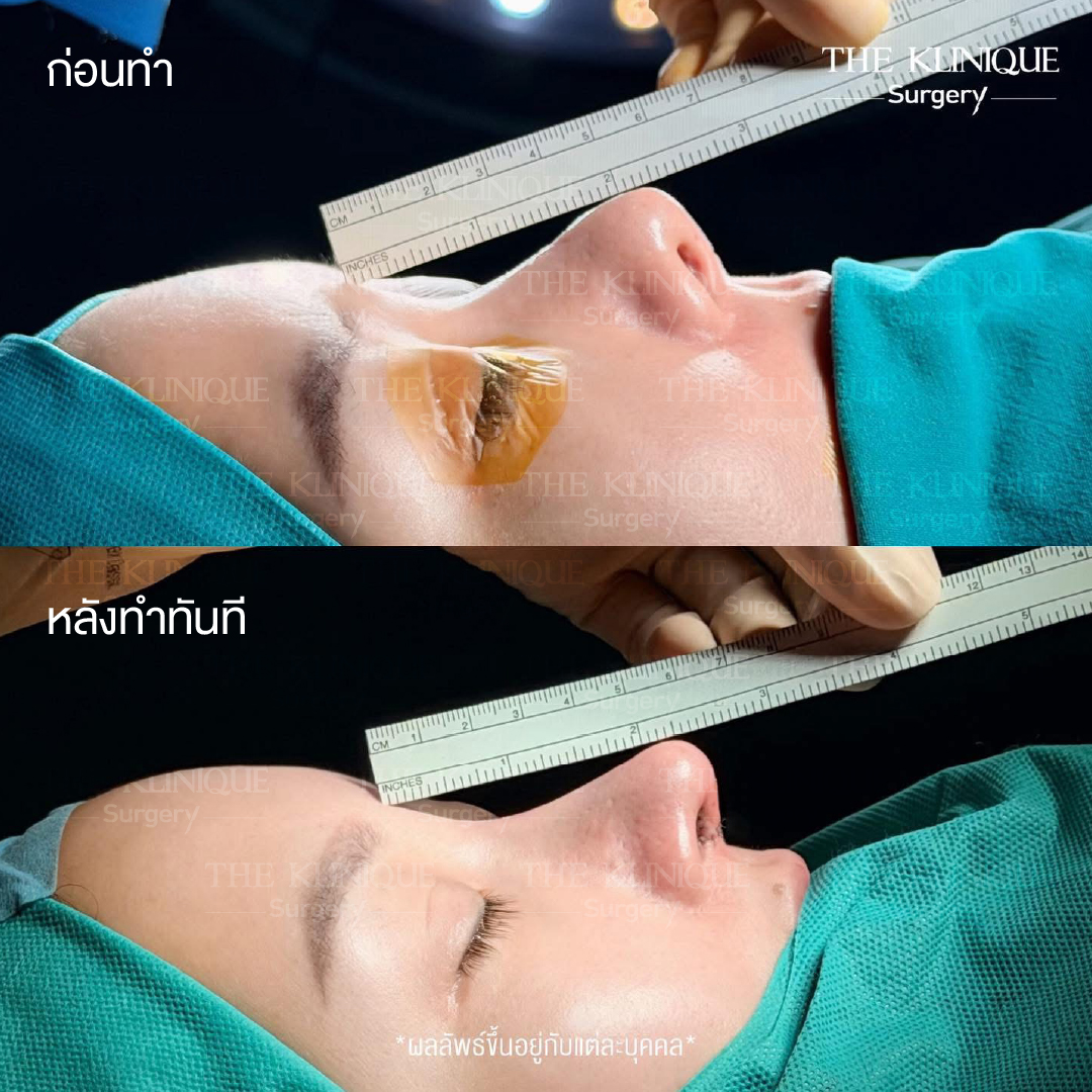 รีวิว หมอบิ๊ก เสริมจมูก เทคนิค OPEN