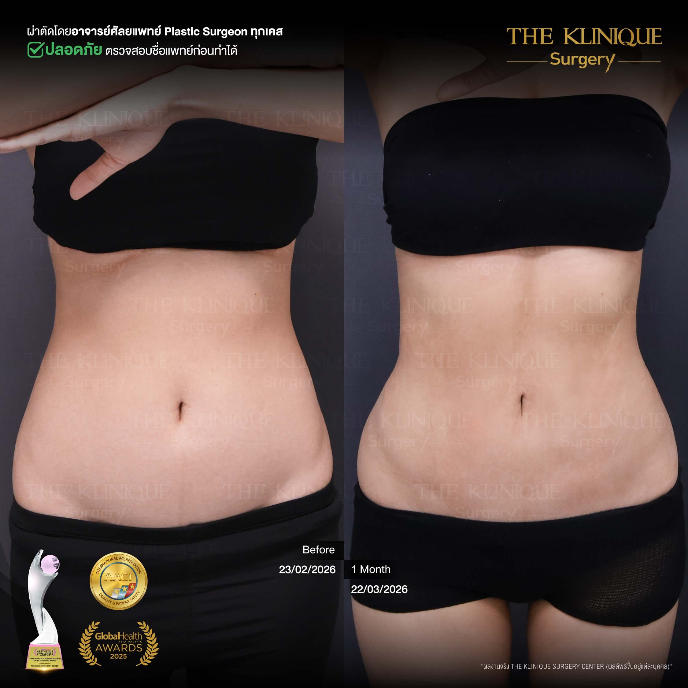 รีวิว ดูดไขมัน Sexyline หน้าท้อง