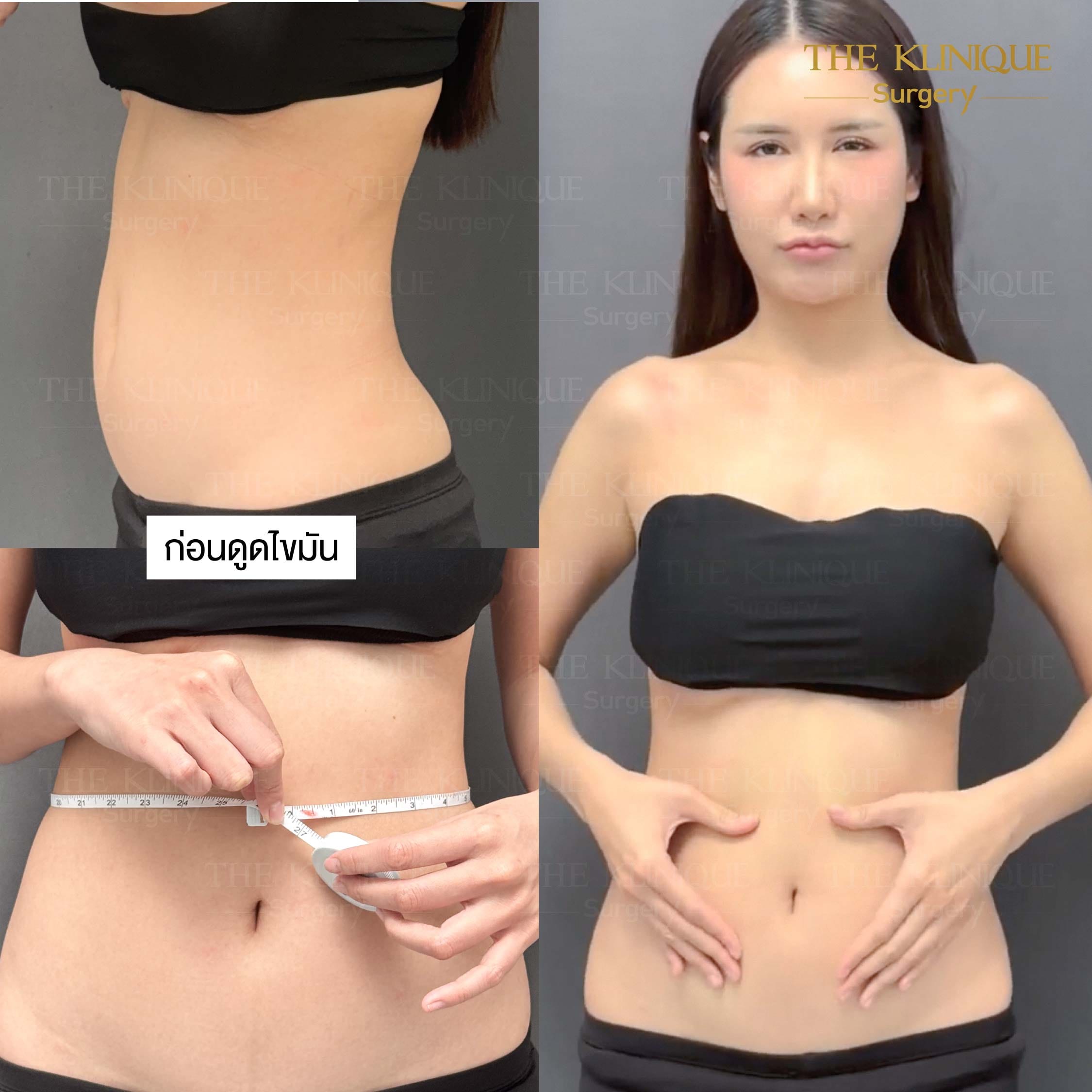 รีวิว ดูดไขมัน Sexyline หน้าท้อง