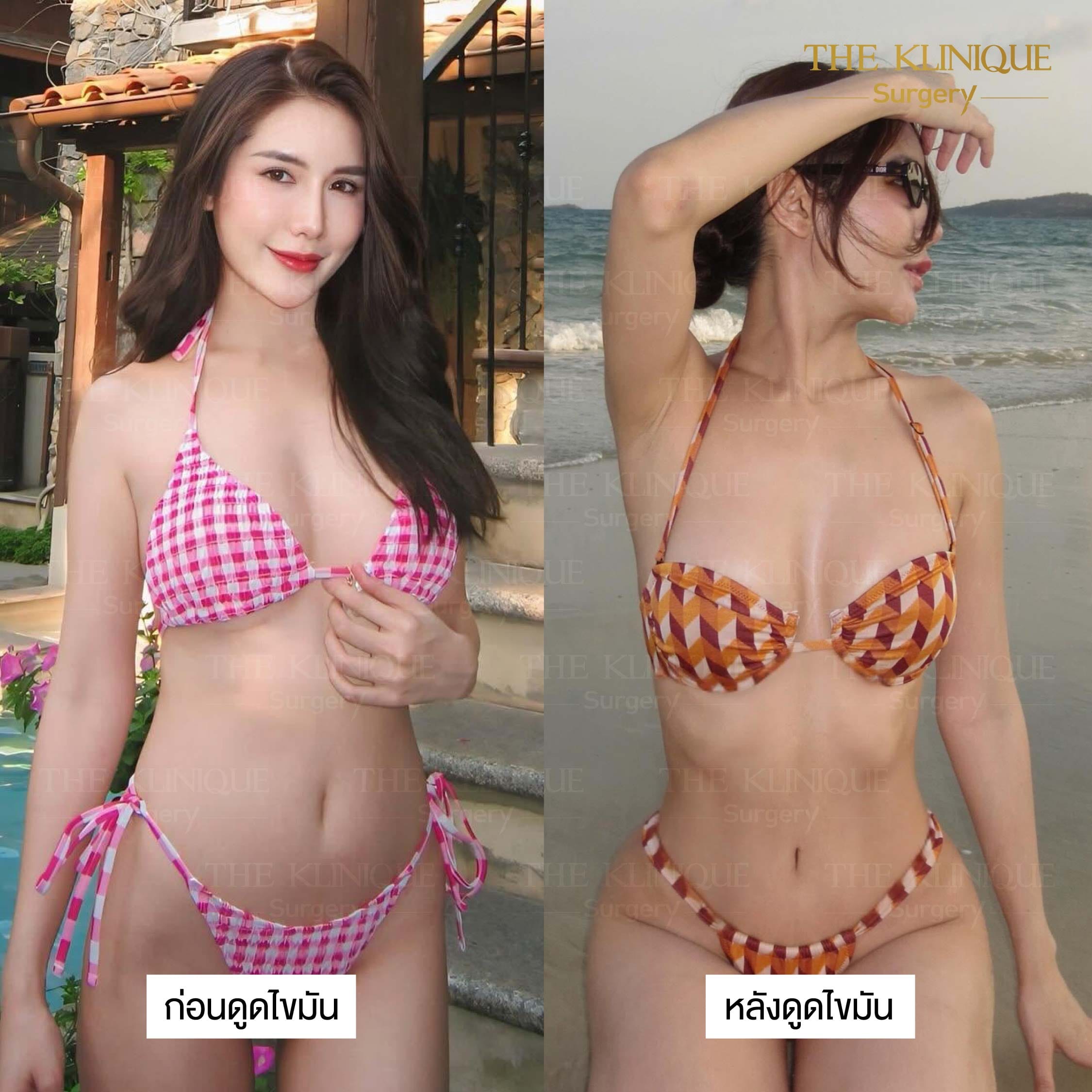 รีวิว ดูดไขมัน Sexyline หน้าท้อง