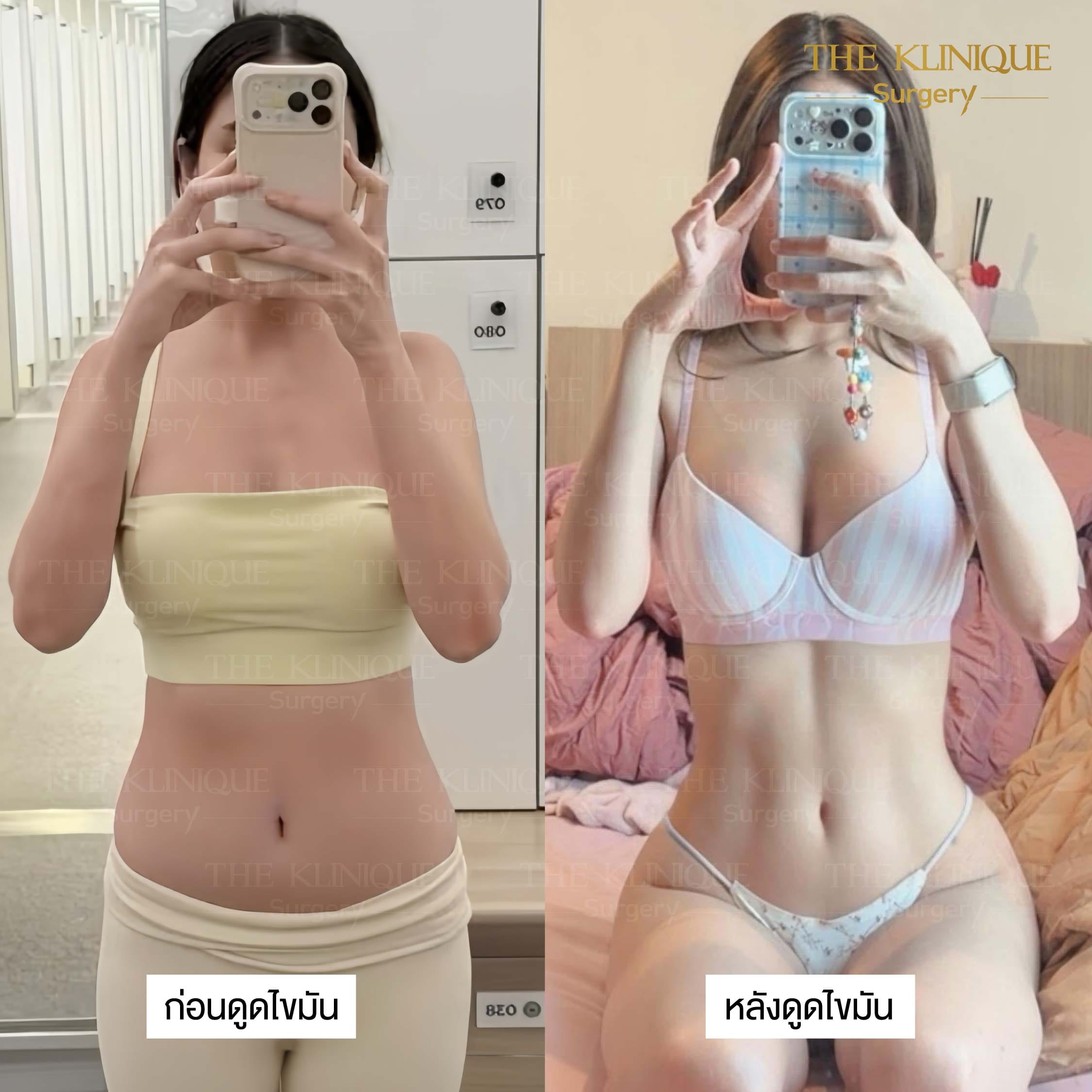 รีวิว ดูดไขมัน Sexyline หน้าท้อง