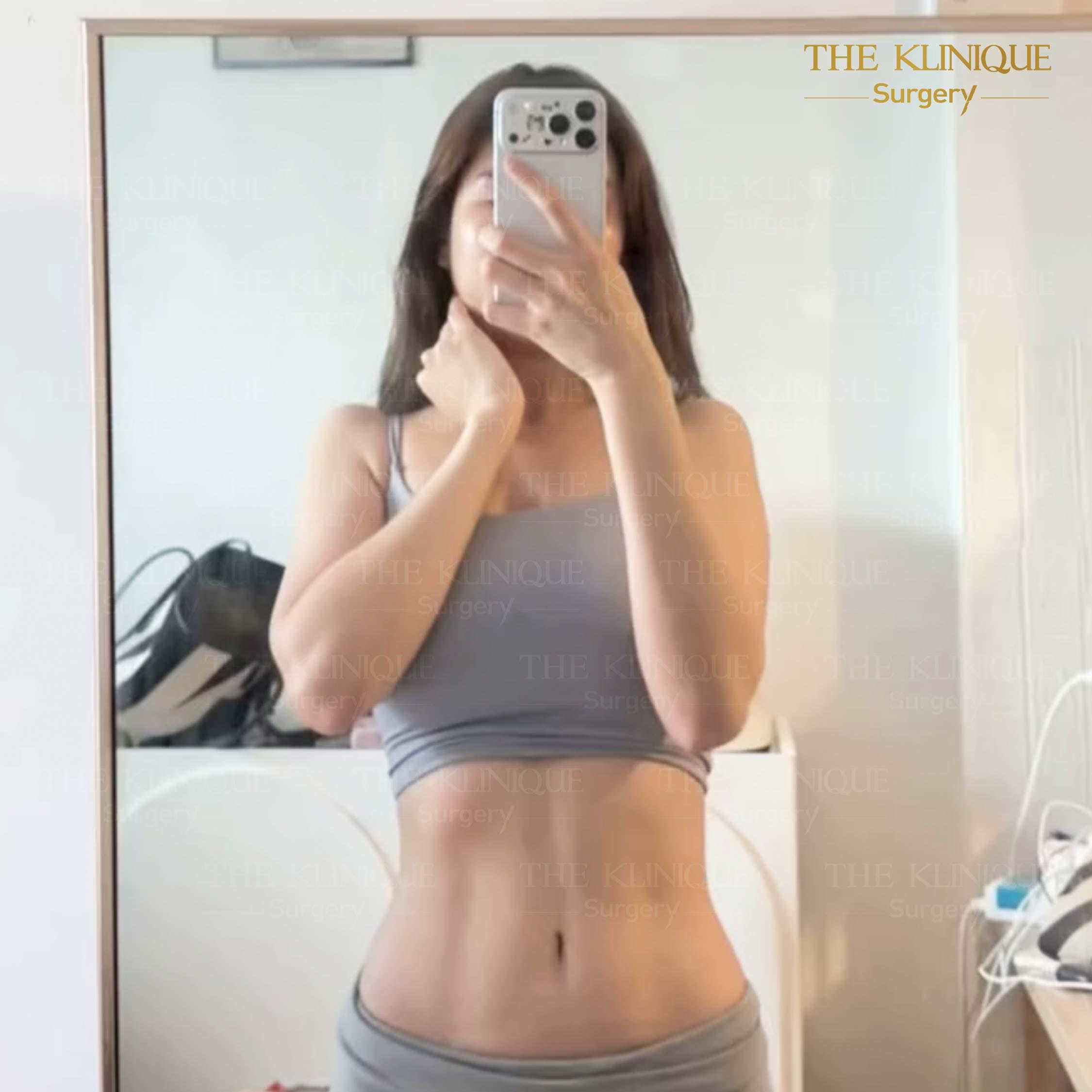 รีวิว ดูดไขมัน Sexyline หน้าท้อง