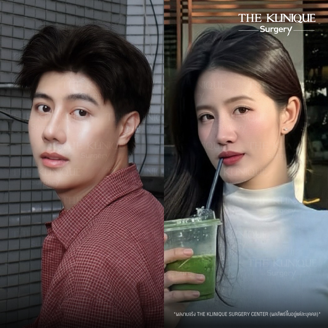 รีวิวเสริมจมูกเทคนิค Semi Open และ Closed
