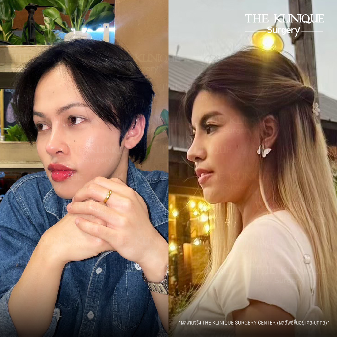 รีวิวเสริมจมูกเทคนิค Semi Open และ Closed