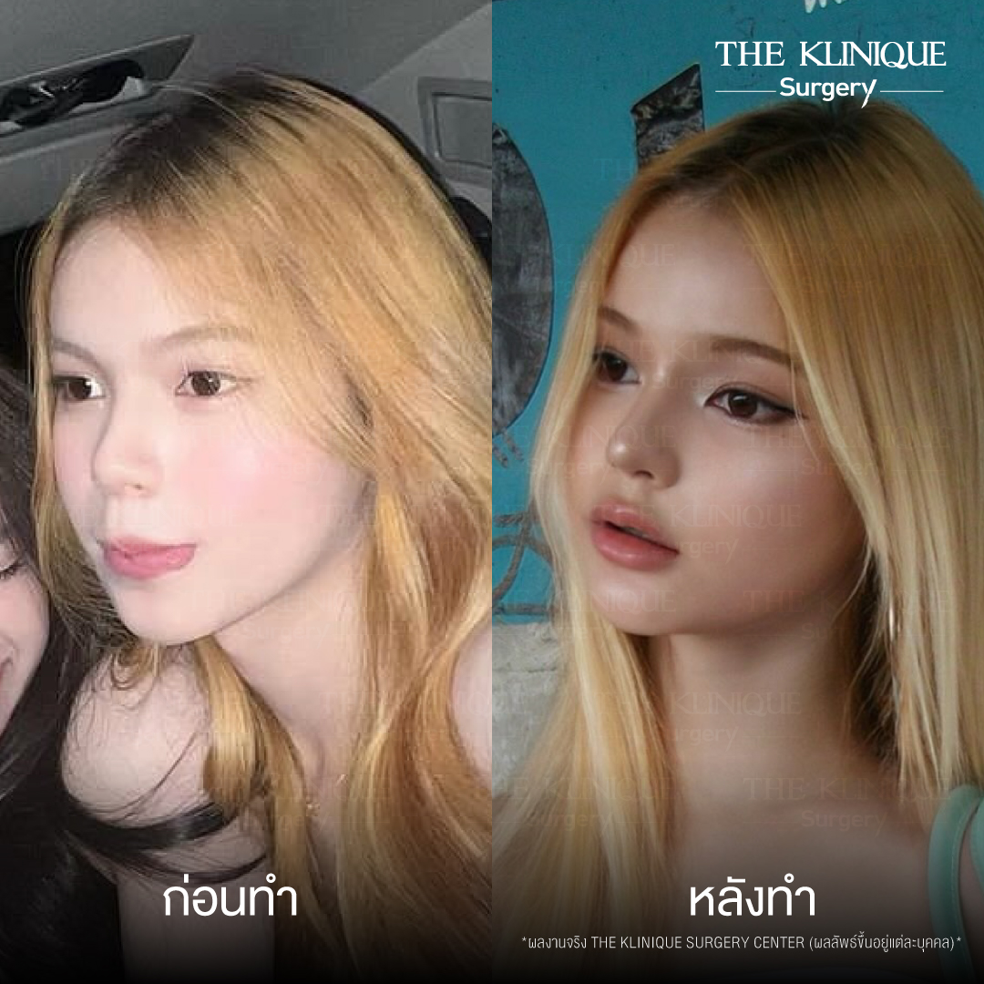 รีวิวเสริมจมูก Semi Open
