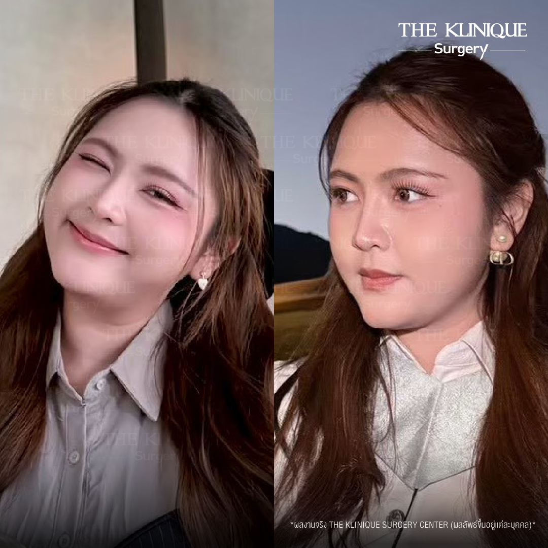 รีวิวเสริมจมูกเทคนิค Semi Open และ Closed